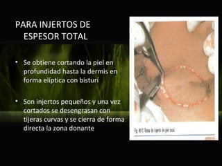 PARA INJERTOS DE
  ESPESOR TOTAL

• Se obtiene cortando la piel en
  profundidad hasta la dermis en
  forma elíptica con bisturí

• Son injertos pequeños y una vez
  cortados se desengrasan con
  tijeras curvas y se cierra de forma
  directa la zona donante
 