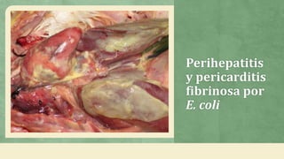 Perihepatitis
y pericarditis
fibrinosa por
E. coli
 