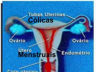 Cólicas  Menstruais Dicas de Como Diminuir a Dor 
