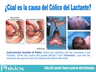 Instrumental durante el Parto:  Como por ejemplo son las Ventosas y los Fórceps. Tanto uno como otro puede afectar a las  “fontanelas”,  que son las zonas en las que se unen los huesos del cráneo del bebé. ¿Cúal es la causa del Cólico del Lactante? Cólico del Lactante: Desde el punto de vista fisioterápico 
