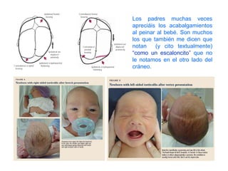 Los padres muchas veces apreciáis los acabalgamientos al peinar al bebé. Son muchos los que también me dicen que notan  (y cito textualmente)  “como un escaloncito”  que no le notamos en el otro lado del cráneo. 