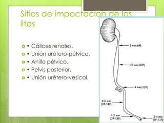 Sitios de impactación de los litos• Cálices renales.• Unión urétero-pélvica.• Anillo pélvico.• Pelvis posterior.• Unión urétero-vesical.