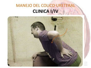 MANEJO DEL COLICO URETERAL
CLINICA I/IV
Dolor súbito de localización lumbar
En el ángulo costovertebral, lateral al músculo sacroespinoso Y debajo de
la 12ª costilla
Aparece cuando la obstrucción migra de la pelvis, al uréter
Generalmente crece y decrece en intensidad, en paroxismos
relacionados con el movimiento de la piedra en el uréter y el
espasmo ureteral asociado.
Suelen durar de 20 a 60 minutos.
 