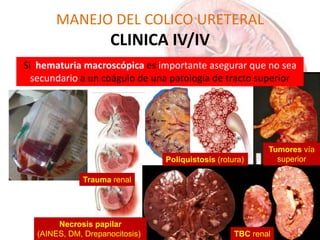 MANEJO DEL COLICO URETERAL
CLINICA IV/IV
Si hematuria macroscópica es importante asegurar que no sea
secundario a un coágulo de una patología de tracto superior
Tumores vía
superior
TBC renal
Trauma renal
Poliquistosis (rotura)
Necrosis papilar
(AINES, DM, Drepanocitosis)
 