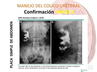 MANEJO DEL COLICO URETERAL
Confirmación IMAGENPLACASIMPLEDEABDOMEN
 