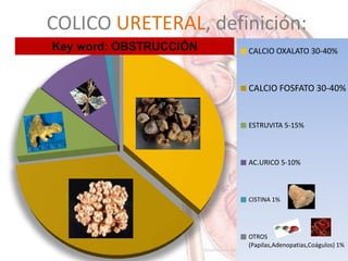 CALCIO OXALATO 30-40%
CALCIO FOSFATO 30-40%
ESTRUVITA 5-15%
AC.URICO 5-10%
CISTINA 1%
OTROS
(Papilas,Adenopatias,Coágulos) 1%
Key word: OBSTRUCCIÓN
COLICO URETERAL, definición:
 