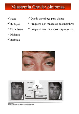 Ptose
Diplopia
Estrabismo
Disfagia
Disfonia
Miastemia Gravis: SintomasMiastemia Gravis: Sintomas
Queda da cabeça para diante
Fraqueza dos músculos dos membros
Fraqueza dos músculos respiratórios
 