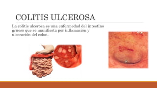 COLITIS ULCEROSA
La colitis ulcerosa es una enfermedad del intestino
grueso que se manifiesta por inflamación y
ulceración del colon.
 