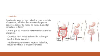 CIRUGÍA
La cirugía para extirpar el colon cura la colitis
ulcerativa y elimina la amenaza de que se
presente cáncer de colon. Se puede necesitar
cirugía si se tiene:
-Colitis que no responde al tratamiento médico
completo.
-Cambios en el revestimiento del colon que
pueden llevar a cáncer.
-Problemas graves como ruptura del colon,
sangrado intenso o megacolon tóxico.
 