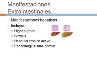Manifestaciones
Extraintestinales
   Manifestaciones hepáticas
   Incluyen:
     Hígado     graso
     Cirrosis

     Hepatitiscrónica activa
     Pericolangitis: mas comun.
 