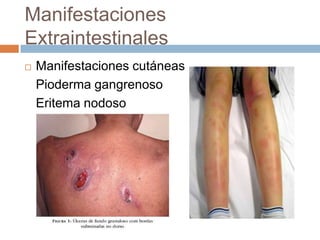 Manifestaciones
Extraintestinales
   Manifestaciones cutáneas
    Pioderma gangrenoso
    Eritema nodoso
 