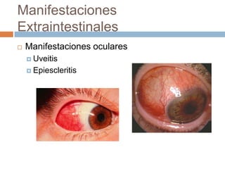 Manifestaciones
Extraintestinales
   Manifestaciones oculares
     Uveitis

     Epiescleritis
 