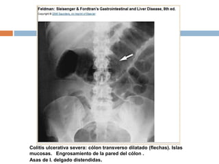 Colitis ulcerativa severa: cólon transverso dilatado (flechas). Islas
mucosas. Engrosamiento de la pared del cólon .
Asas de I. delgado distendidas.
 