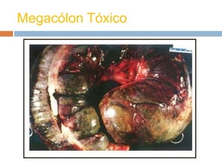 Megacólon Tóxico
 
