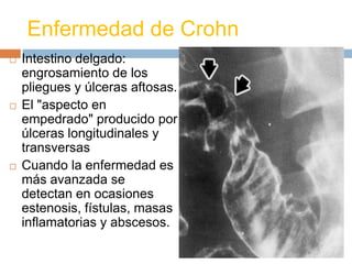 Enfermedad de Crohn
   Intestino delgado:
    engrosamiento de los
    pliegues y úlceras aftosas.
   El "aspecto en
    empedrado" producido por
    úlceras longitudinales y
    transversas
   Cuando la enfermedad es
    más avanzada se
    detectan en ocasiones
    estenosis, fístulas, masas
    inflamatorias y abscesos.
 