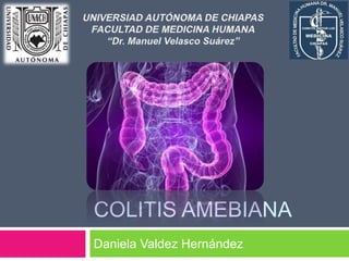 COLITIS AMEBIANA 
Daniela Valdez Hernández 
 