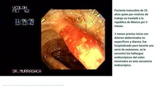Paciente masculino de 33
años quien por motivos de
trabajo se trasladó a la
república de México por 5
meses.
3 meses previos inicia con
dolores abdominales no
específicos y diarrea, fue
hospitalizado para hacerle una
serie de exámenes, se le
encontró los hallazgos
endoscópicos del colon
mostrados en esta secuencia
endoscópica.
Longo, D., & Fauci, A. S. (2013). Harrison’s Gastroenterology and Hepatology (2a ed.). McGraw-Hill Medical.
 