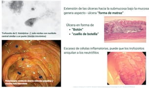 Trofozoito de E. histolytica - 1 solo núcleo con nucléolo
central similar a un punto (tinción tricrómica)
Extensión de las úlceras hacia la submucosa bajo la mucosa
genera aspecto - úlcera “forma de matraz”
Úlcera en forma de
“Botón”
“cuello de botella”
Escasez de células inflamatorias, puede que los trofozoitos
aniquilan a los neutrófilos
Longo, D., & Fauci, A. S. (2013). Harrison’s Gastroenterology and Hepatology (2a ed.). McGraw-Hill Medical.
 