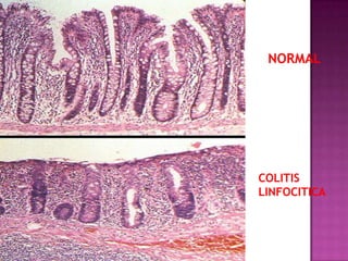 NORMAL




COLITIS
LINFOCITICA
 