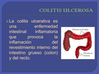 COLITIS ULCEROSALa colitis ulcerativa es una enfermedad intestinal inflamatoria que provoca la inflamación del revestimiento interno del intestino grueso (colon) y del recto. 