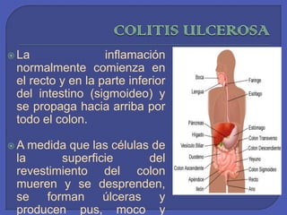 COLITIS ULCEROSALa inflamación normalmente comienza en el recto y en la parte inferior del intestino (sigmoideo) y se propaga hacia arriba por todo el colon. A medida que las células de la superficie del revestimiento del colon mueren y se desprenden, se forman úlceras y producen pus, moco y hemorragia.