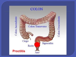 Proctitis