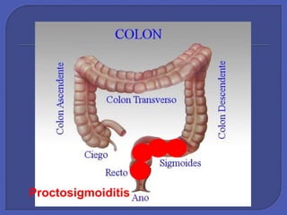 Proctosigmoiditis