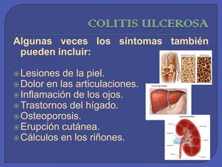 COLITIS ULCEROSAAlgunas veces los síntomas también pueden incluir:Lesiones de la piel. Dolor en las articulaciones. Inflamación de los ojos. Trastornos del hígado. Osteoporosis. Erupción cutánea. Cálculos en los riñones. 