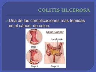 COLITIS ULCEROSAUna de las complicaciones mas temidas es el cáncer de colon. 