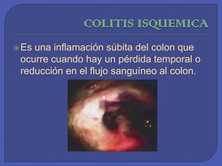 COLITIS ISQUEMICAEs una inflamación súbita del colon que ocurre cuando hay un pérdida temporal o reducción en el flujo sanguíneo al colon. 