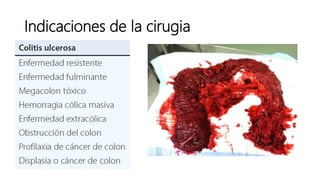 Indicaciones de la cirugia
 