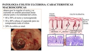 PATOLOGIA COLITIS ULCEROSA: CARACTERISTICAS
MACROSCOPICAS
abarca por lo regular el recto y se
extiende en sentido proximal hasta
afectar parte o la totalidad del colon.
• 40 a 50% al recto y rectosigmoide
• 30 a 40% rebasa el sigmoide pero no
compromete todo el colon
• 20% la colitis es total.
 