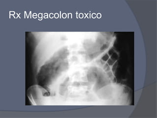 Rx Megacolon toxico