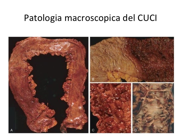 Colitis ulcerosa partnersuche
