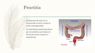 Proctitis
– La extensión de esta CU se
circunscribe al recto o hasta la
unión rectosigmoidea.
– Su tratamiento puede abordarse
por vía sistémica y/o tópica en
forma de enema, espuma o
supositorios.
 
