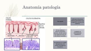 Anatomía patología
Afecta la mucosa del
colon, 95%de la
mucosa rectal
Macro. La mucosa
tiene un aspecto
granular e
hiperemico.
Comienza como
erosiones
Progresa hasta afectar
a la mucosa en toda
su profundidad
Afecta a toda la
mucosa en toda su
profundidad, todo el
colon
Ileitis por reflujo,
Afecta hasta 5, 25 cm
del íleon terminal
Fase aguda
Infiltrado linfocitario,
células plasmáticas con
congestión venosa y de
capilares.
En las criptas se
observa pequeños
absceso, donde existen
una reducción del nro
de células mucoides.
CUANDO LA
ENFERMEDAD
DISMINUYE
Los abscesos en criptas
desaparecen, las
celuas mucoides se
recuperan.
 