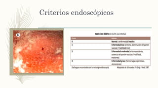 Criterios endoscópicos
– La mucosa colonica en la fase de
actividad presenta una apariencia
granular, perdida del patrón vascular,
eritema difuso y hemorragia
espontanea o al rose con el
endoscopio.
– la gravedad de las lesiones se
correlaciona con el grado de
actividad de la enfermedad.
– Afecta siempre desde el recto en
sentido proximal.
 