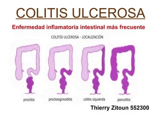 COLITIS ULCEROSA Enfermedad inflamatoria intestinal más frecuente Thierry Zitoun 552300 