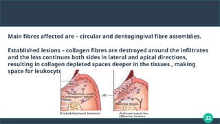 32
Main fibres affected are – circular and dentogingival fibre assemblies.
Established lesions – collagen fibres are destroyed around the infiltrates
and the loss continues both sides in lateral and apical directions,
resulting in collagen depleted spaces deeper in the tissues , making
space for leukocyte infiltration
 