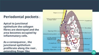 33
Periodontal pockets :
Apical to junctional
epithelium the collagen
fibres are destroyed and the
area becomes occupied by
inflammatory cells.
As a consequence , the
junctional epithelium
proliferate along the root ,
extending finger like
 