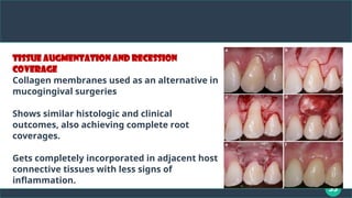 35
Tissue augmentation and recession
coverage
Collagen membranes used as an alternative in
mucogingival surgeries
Shows similar histologic and clinical
outcomes, also achieving complete root
coverages.
Gets completely incorporated in adjacent host
connective tissues with less signs of
inflammation.
 
