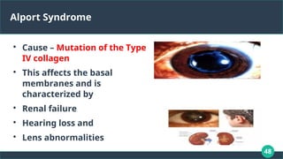48
Alport Syndrome

Cause – Mutation of the Type
IV collagen

This affects the basal
membranes and is
characterized by

Renal failure

Hearing loss and

Lens abnormalities
 