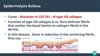 49
Epidermolysis Bullosa

Cause – Mutation in COL7A1 , of type VII collagen

Function of type VII collagen is to form delicate fibrils
that anchor the basal lamina to collagen fibrils in the
dermis.

In this disease , there is reduction in the anchoring fibrils ,
thus causing friction and blistering.
 