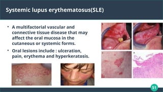 51
Systemic lupus erythematosus(SLE)

A multifactorial vascular and
connective tissue disease that may
affect the oral mucosa in the
cutaneous or systemic forms.

Oral lesions include : ulceration,
pain, erythema and hyperkeratosis.
 