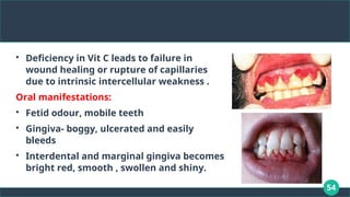 54

Deficiency in Vit C leads to failure in
wound healing or rupture of capillaries
due to intrinsic intercellular weakness .
Oral manifestations:

Fetid odour, mobile teeth

Gingiva- boggy, ulcerated and easily
bleeds

Interdental and marginal gingiva becomes
bright red, smooth , swollen and shiny.
 