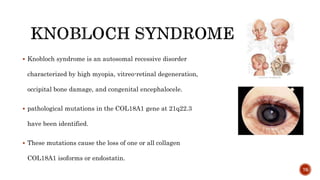  Knobloch syndrome is an autosomal recessive disorder
characterized by high myopia, vitreo-retinal degeneration,
occipital bone damage, and congenital encephalocele.
 pathological mutations in the COL18A1 gene at 21q22.3
have been identified.
 These mutations cause the loss of one or all collagen
COL18A1 isoforms or endostatin.
76
 