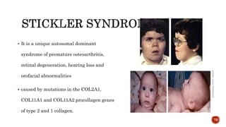  It is a unique autosomal dominant
syndrome of premature osteoarthritis,
retinal degeneration, hearing loss and
orofacial abnormalities
 caused by mutations in the COL2A1,
COL11A1 and COL11A2 procollagen genes
of type 2 and 1 collagen.
78
 
