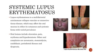  Lupus erythematosus is a multifactorial
autoimmune collagen vascular or connective
tissue disease, which may affect the oral
mucosa in either its cutaneous and systemic
forms with varied prevalence
 Oral lesions include ulceration, pain,
erythema and hyperkeratosis. Other oral
complaints are xerostomia, stomatodynia,
candidiasis, periodontal disease and
dysgeusia.
82
 