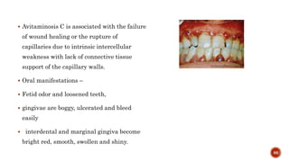  Avitaminosis C is associated with the failure
of wound healing or the rupture of
capillaries due to intrinsic intercellular
weakness with lack of connective tissue
support of the capillary walls.
 Oral manifestations –
 Fetid odor and loosened teeth,
 gingivae are boggy, ulcerated and bleed
easily
 interdental and marginal gingiva become
bright red, smooth, swollen and shiny.
86
 