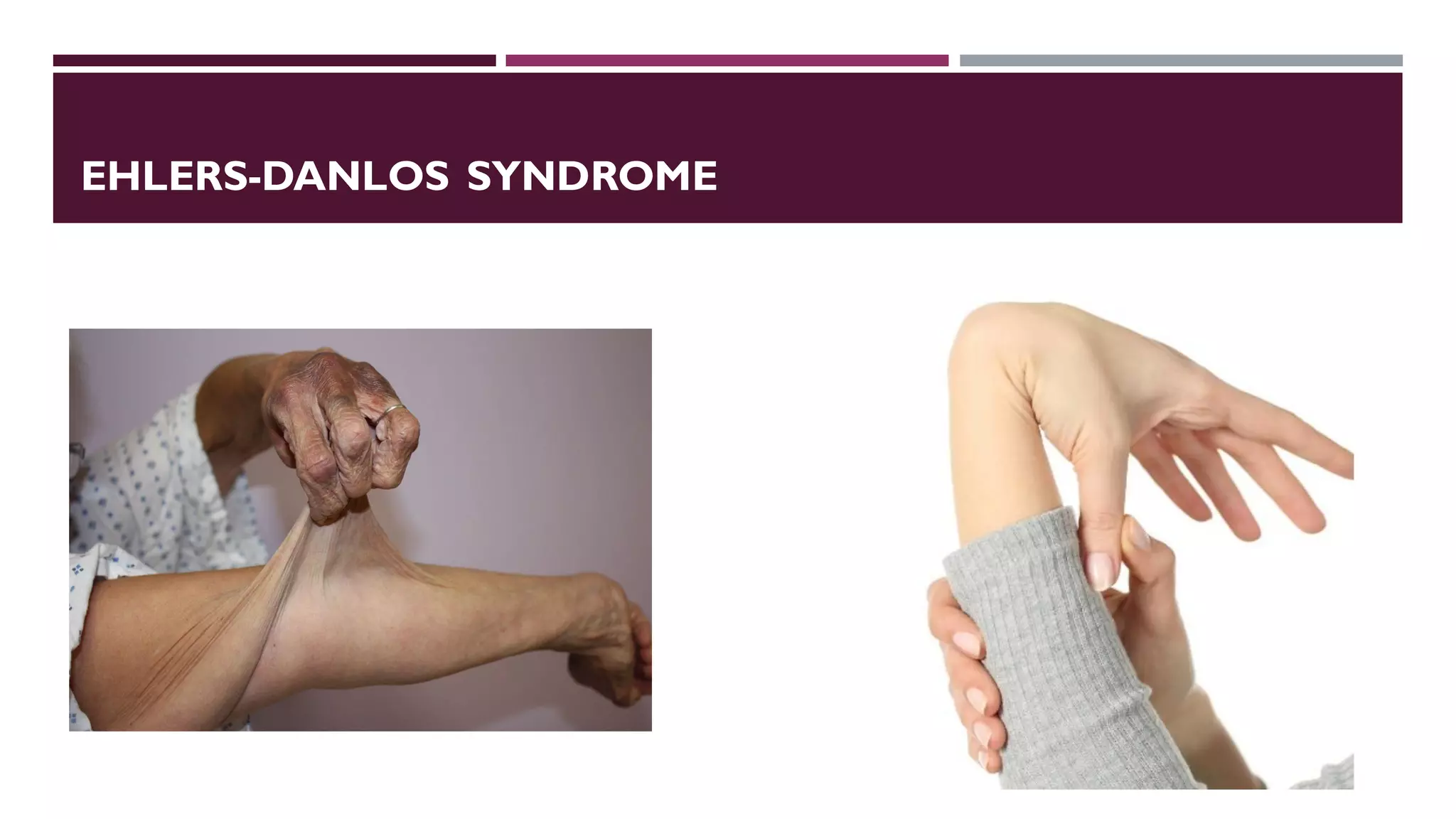 EHLERS-DANLOS SYNDROME
 